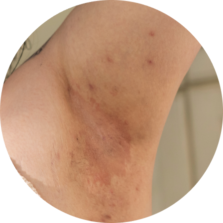 Image of mild HS rash